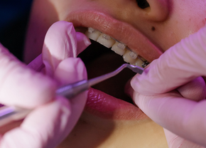 Totul despre aparatul dentar – ce este, beneficii și riscuri