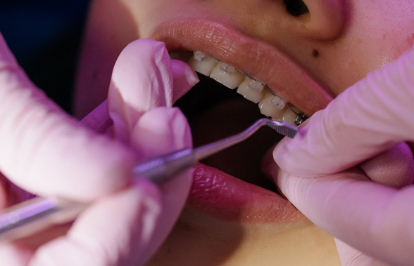 Totul despre aparatul dentar - ce este, beneficii și riscuri
