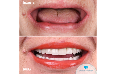 Dinți pierduți în urma antrenamentelor sportive: de ce să nu mai amâni implantul dentar complet