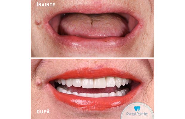 Dinți pierduți în urma antrenamentelor sportive: de ce să nu mai amâni implantul dentar complet