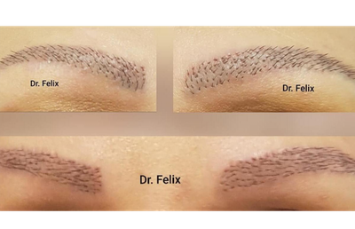 Intervențiile estetice, sportul femeilor - implant de sprâncene la Dr. Felix Hair Implant