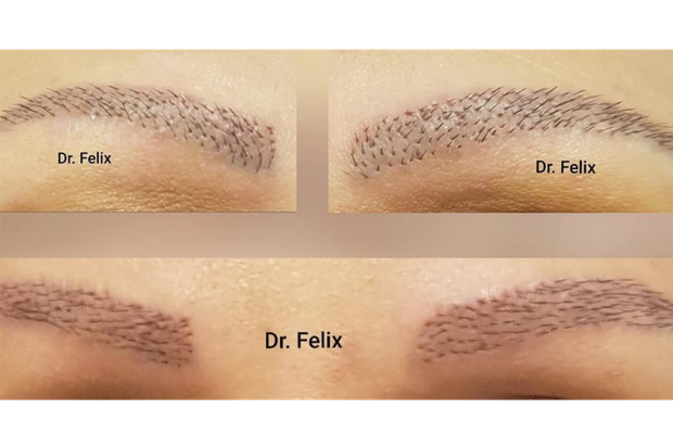 Intervențiile estetice, sportul femeilor - implant de sprâncene la Dr. Felix Hair Implant