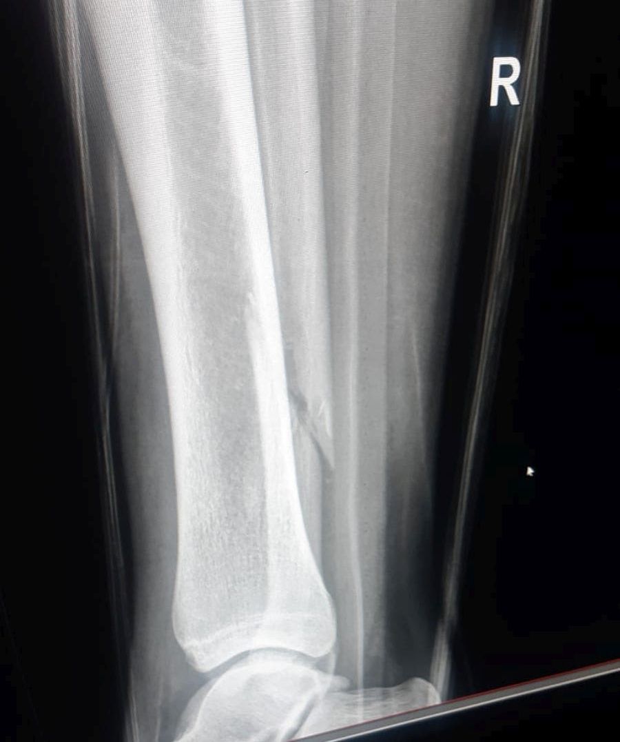 Radiografia lui Koljoc care arată fractura peroneului Radiografia lui Koljoc care arată fractura peroneului