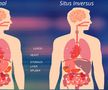 Situs inversus, anomalia congenitală în cadrul căreia anumite organe sunt situate în partea opusă față de situația normală / Sursă foto: HealthJade.net