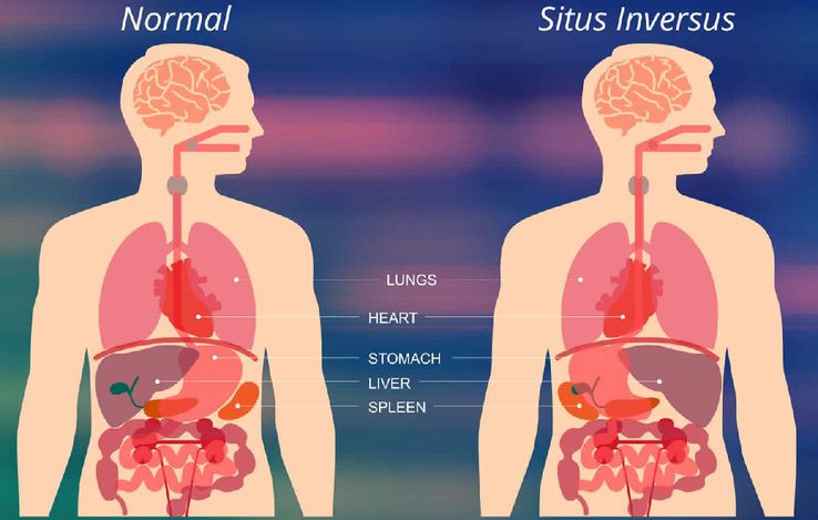 Situs inversus, anomalia congenitală în cadrul căreia anumite organe sunt situate în partea opusă față de situația normală / Sursă foto: HealthJade.net