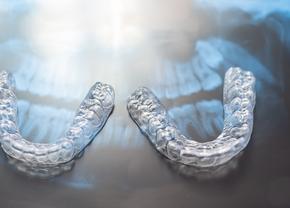 De ce să alegi un aparat dentar invizibil? 5 avantaje importante