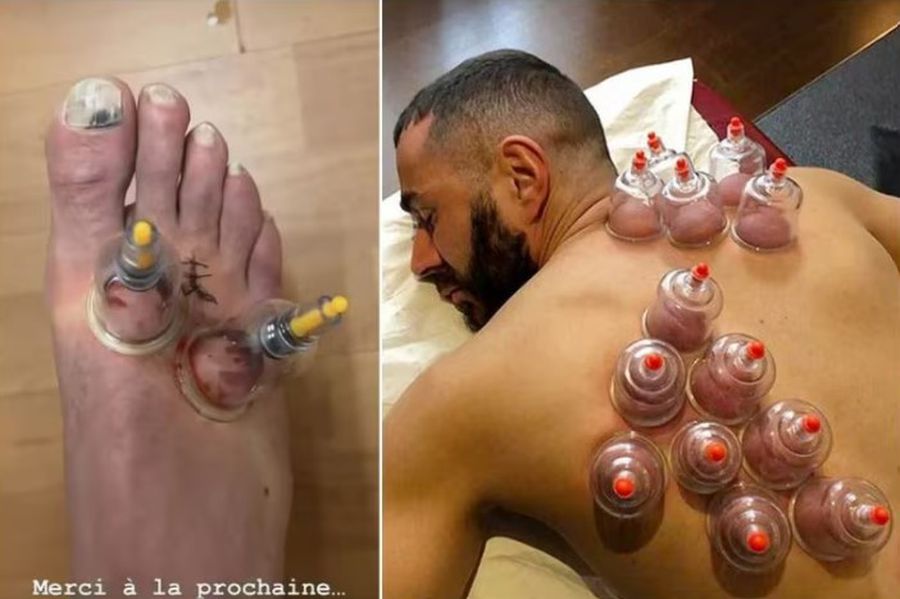 Imagine șocantă cu vârful de 44 de milioane! » Și-a acoperit tot corpul de ventuze