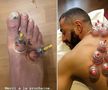 Și Karim Benzema s-a tratat cu ventuze pentru o mai bună refacere musculară / Foto: Instagram