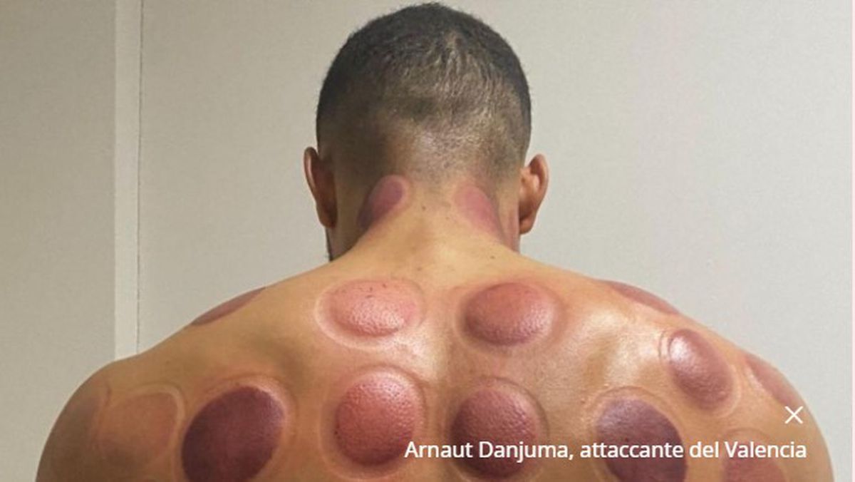 Atacantul lui Juventus, belgianul Louis Openda, terapie neconvențională cu ventuze