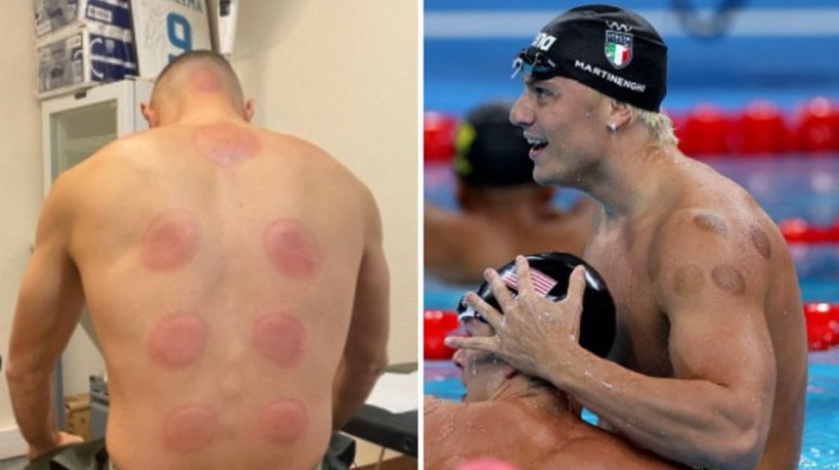 Atacantul lui Juventus, belgianul Louis Openda, terapie neconvențională cu ventuze