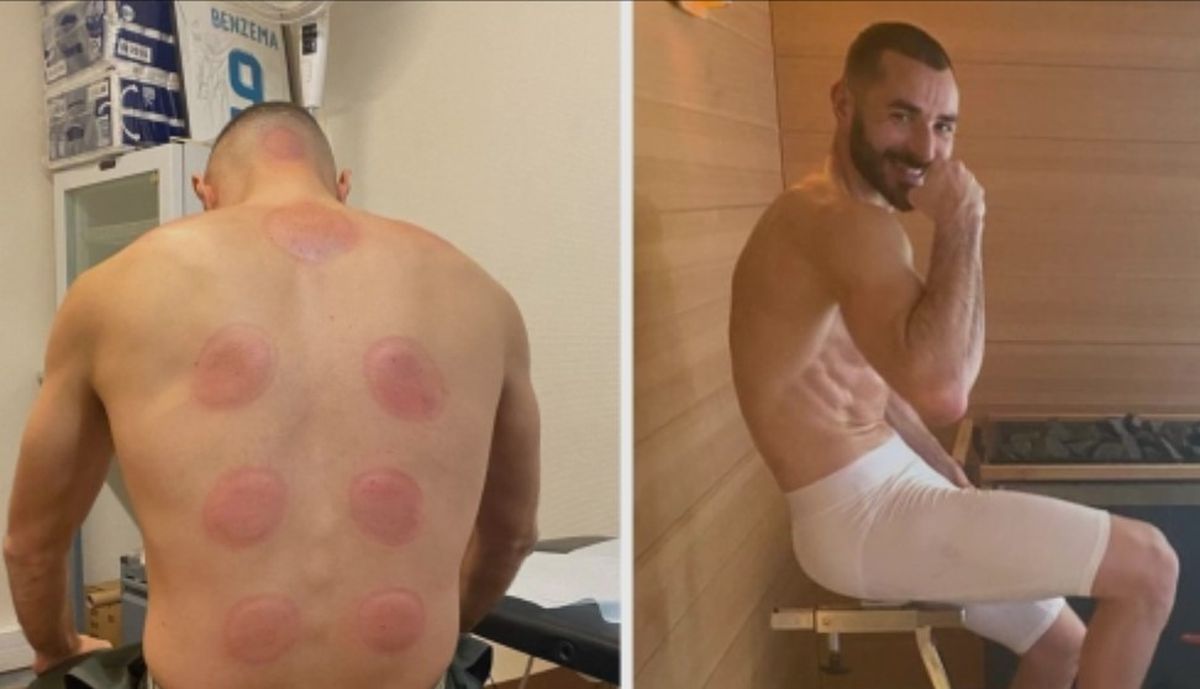 Atacantul lui Juventus, belgianul Louis Openda, terapie neconvențională cu ventuze