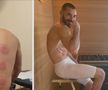 Și Karim Benzema s-a tratat cu ventuze pentru o mai bună refacere musculară / Foto: Instagram