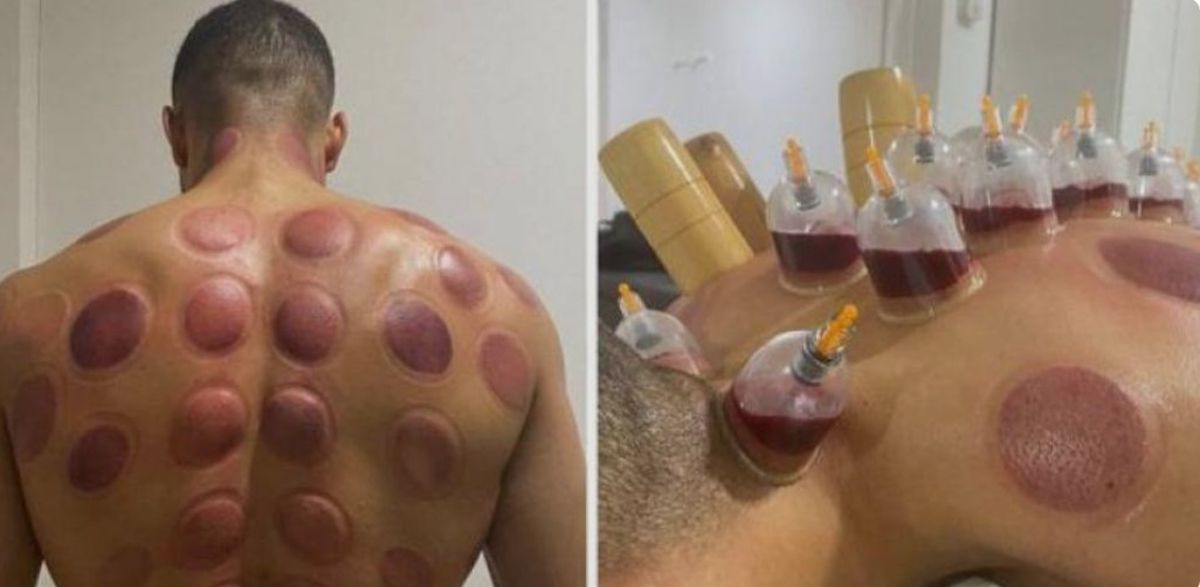 Atacantul lui Juventus, belgianul Louis Openda, terapie neconvențională cu ventuze