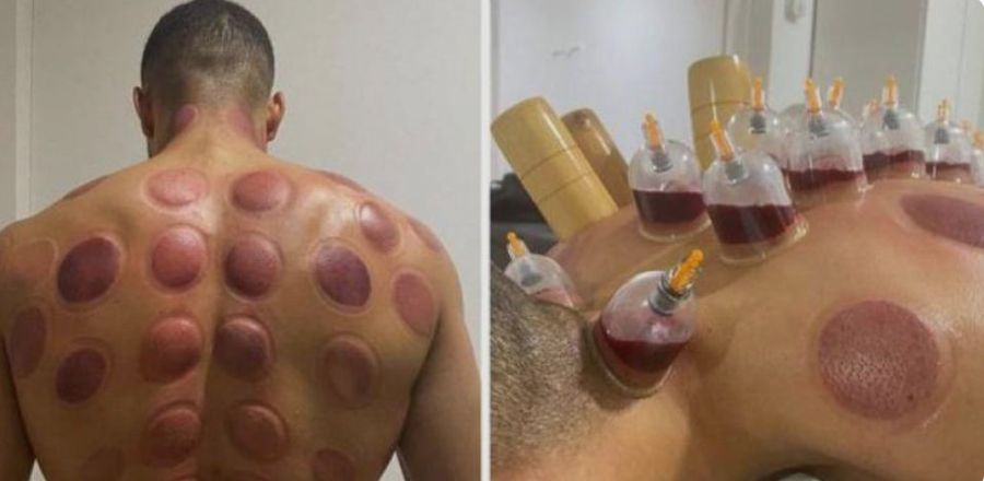 Imagine șocantă cu vârful de 44 de milioane! » Și-a acoperit tot corpul de ventuze