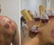 Louis Openda s-a tratat cu ventuze pentru o mai bună refacere musculară și eliminarea toxinelor din corp / Foto: Instagram
