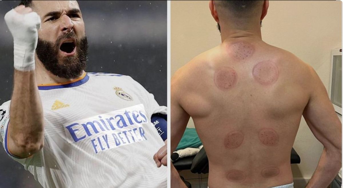 Atacantul lui Juventus, belgianul Louis Openda, terapie neconvențională cu ventuze