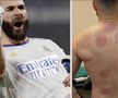 Și Karim Benzema s-a tratat cu ventuze pentru o mai bună refacere musculară / Foto: Instagram