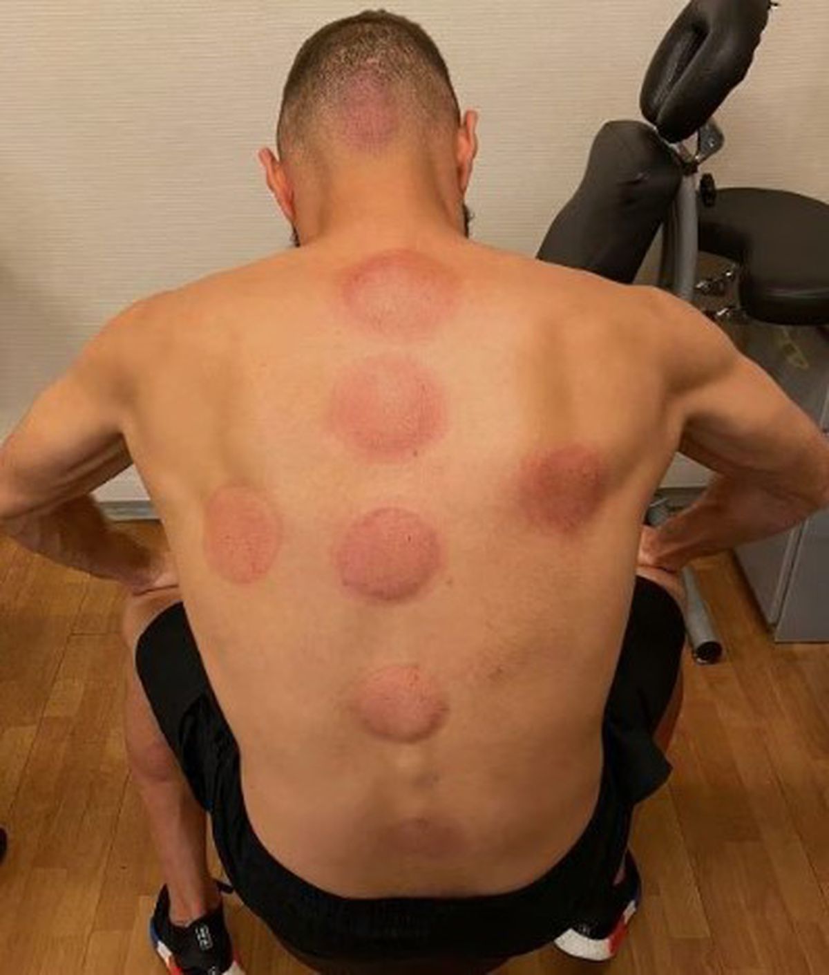 Atacantul lui Juventus, belgianul Louis Openda, terapie neconvențională cu ventuze