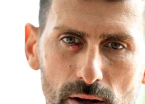 Ochiul lui Novak Djokovic nu arată bine! A fost fotografiat de aproape, iar imaginea îi îngrijorează pe fanii sârbului