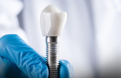 Cât contează prețul atunci când alegi o restaurare dentară