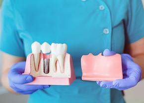 Cum are loc intervenția de implant dentar? Care sunt etapele principale?