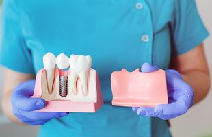 Cum are loc intervenția de implant dentar? Care sunt etapele principale?