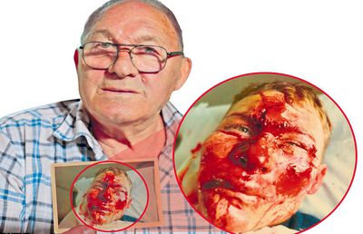 Povestea cutremurătoare a unui român care a șocat Mondialul: „Fața mea a fost pe post de frână, durerea nu poate fi descrisă”. Ce a urmat e de neimaginat: „Doctorul a cerut urgent o poză cu mine”