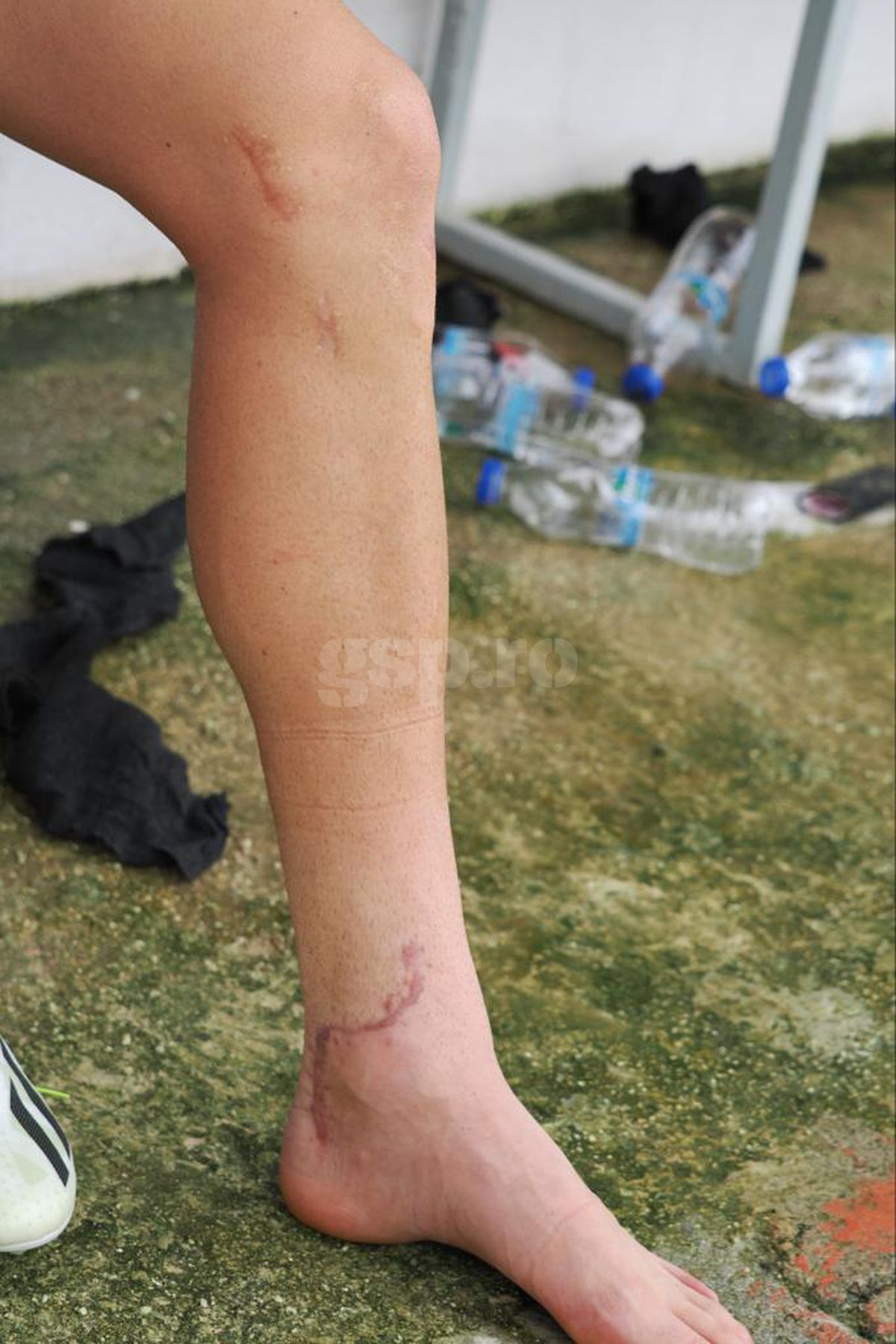 Imagini brutale surprinse de GSP în Antalya! Cum arată acum piciorul lui Dragoș Iancu, la aproape 4 luni de la teribila accidentare