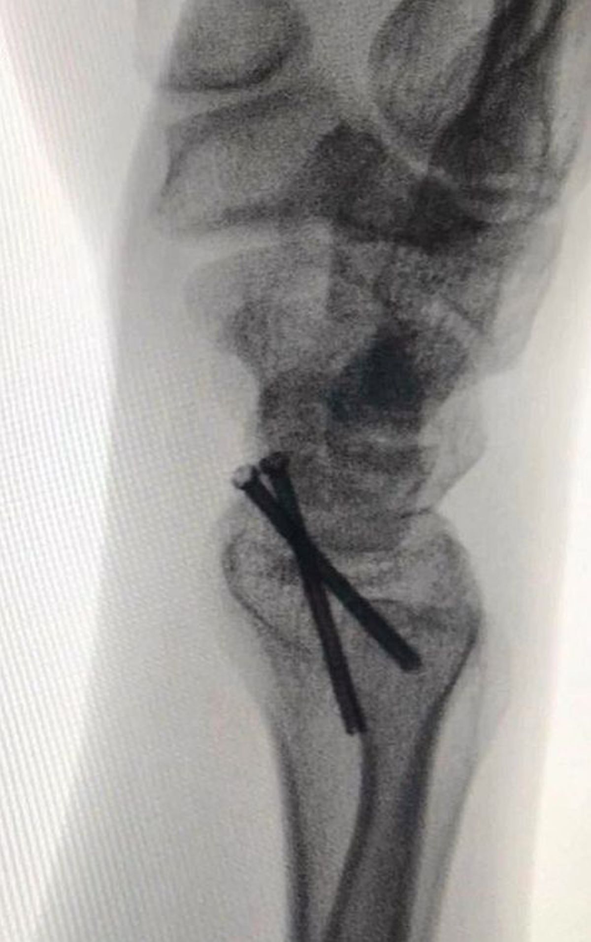 Calvarul prin care a trecut Lance Stroll pentru a lua startul în prima cursă de Formula 1 » Operat de urgență cu 12 zile înainte