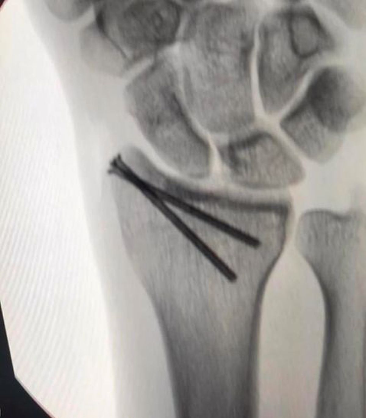 Calvarul prin care a trecut Lance Stroll pentru a lua startul în prima cursă de Formula 1 » Operat de urgență cu 12 zile înainte