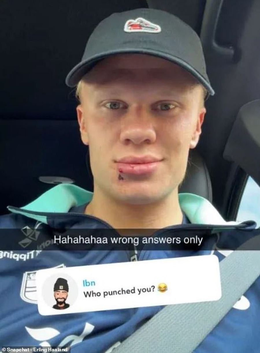 Haaland a apărut „șifonat” la față: „Cine te-a lovit?”