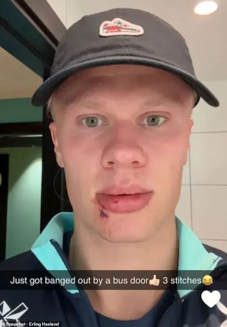 Haaland a apărut „șifonat” la față: „Cine te-a lovit?”