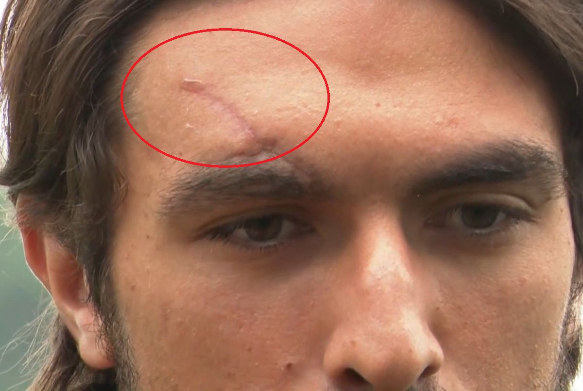 „Ștampilat” pe viață » Ciocnirea cu Olaru a lăsat o urmă adâncă pe fruntea lui Compagno: „90 de minute urâte”