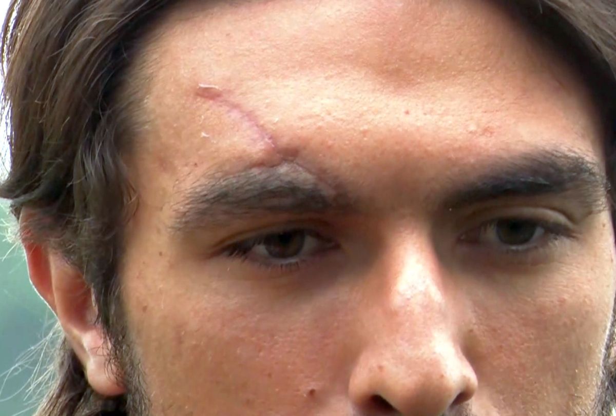 Cicatricea lui Andrea Compagno, după ciocnirea cu Darius Olaru