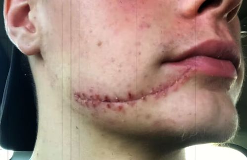 Jens van 't Wout s-a pozat imediat după operație