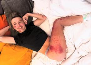Poloneza Katarzyna Niewiadoma și-a arătat rănile căpătate în cursa Strade Bianche