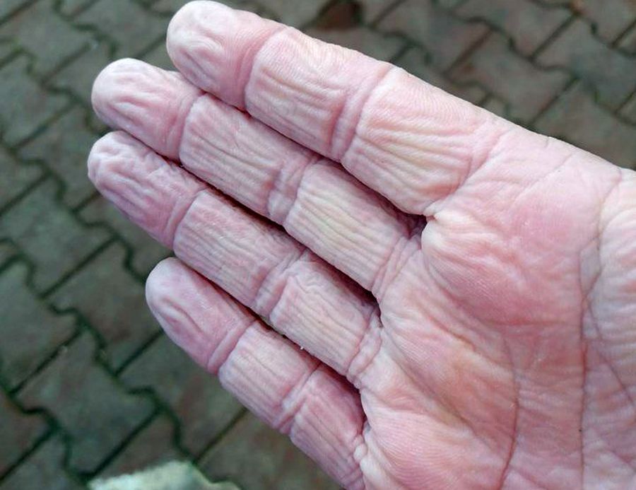 COVID-19. FOTO Cum arată mâinile unui cadru medical din Suceava, după o tură de 12 ore: „E infernal”