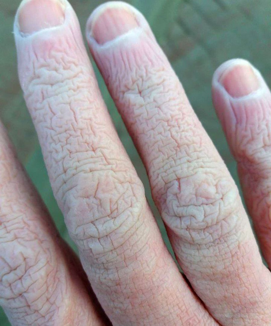 COVID-19. FOTO Cum arată mâinile unui cadru medical din Suceava, după o tură de 12 ore: „E infernal”