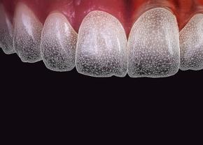 Faţete dentare şi inteligenţa artificială: o introducere în inovaţia stomatologiei