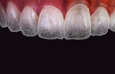 Faţete dentare şi inteligenţa artificială: o introducere în inovaţia stomatologiei