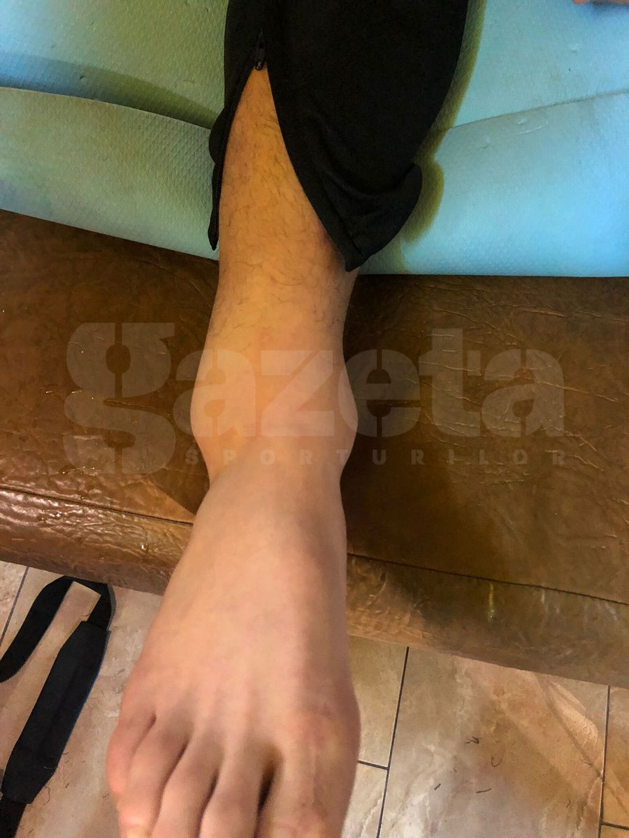 Cum arată piciorul lui Achahbar, după accidentarea din Rapid - Sepsi
