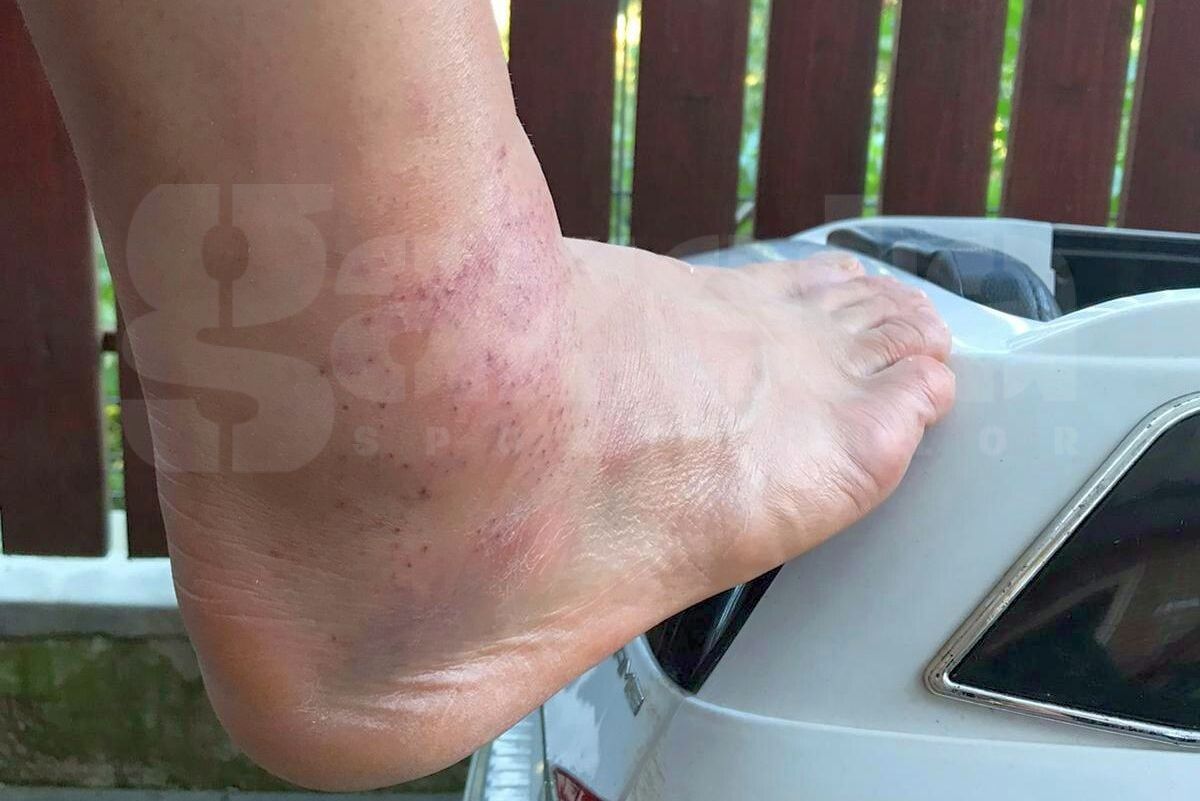 E cât un butuc! » Cum arată glezna lui Ciprian Deac, a doua zi după atacul brutal din UTA - CFR Cluj