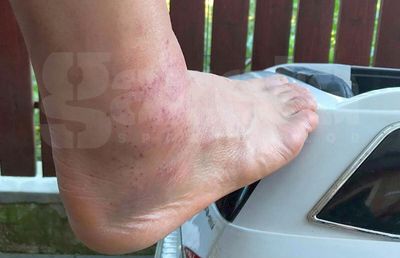 E cât un butuc! » Cum arată glezna lui Ciprian Deac, a doua zi după atacul brutal din UTA - CFR Cluj