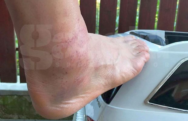 E cât un butuc! » Cum arată glezna lui Ciprian Deac, a doua zi după atacul brutal din UTA - CFR Cluj