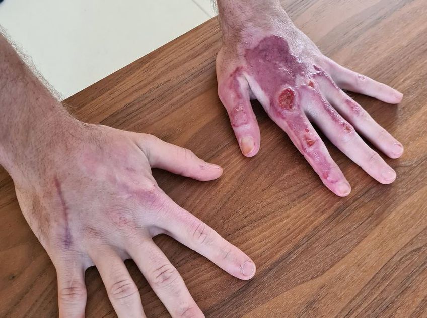 Mâinile lui Romain Grosjean după scoaterea bandajelor