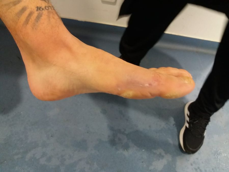 FOTO EXCLUSIV. I-a tăiat gheata în Craiova - Sepsi! Cum arată acum piciorul fotbalistului » Crăciunescu: „I-aș fi dat «roșu»!”
