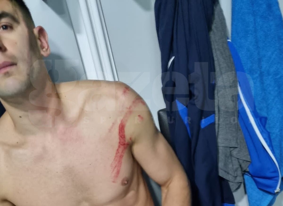 Cu fața bandajată, Armaș a răbufnit: „Nu îl înțeleg pe Edjouma, cum să faci așa ceva? Putea să mă desfigureze!”