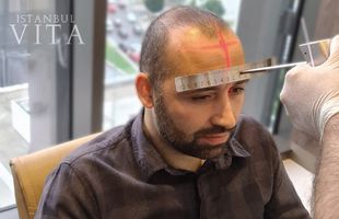 Implant de păr Turcia - Cel mai bun centru IstanbulVita