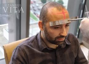 Implant de păr Turcia - Cel mai bun centru IstanbulVita