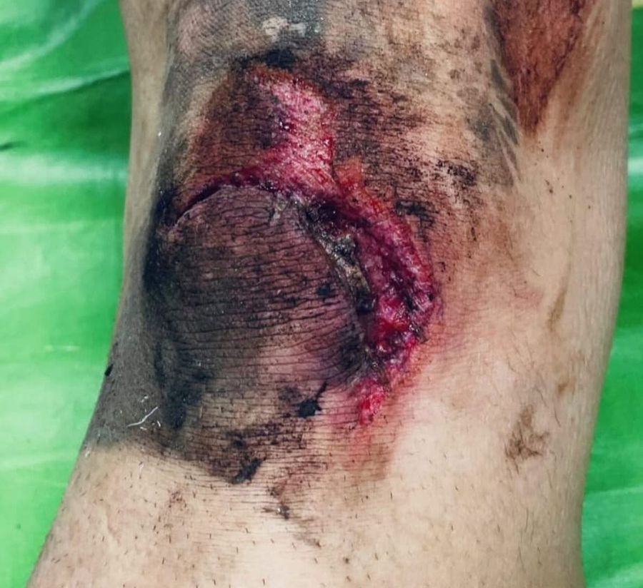 Așa arată, în urma impactului, genunchiul lui Florian Haită / Sursă foto: Instagram Accidentare de coșmar în Liga 2 din România! Fotbalistul crescut de Hagi și-a făcut franjuri genunchiul: „Am căzut într-o buză de canal din fier!” » Reacția clubului: „Ce canal? Era nisip”